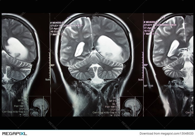 Mri Of Brain Left Hemisphere Tumor Coronal Plane Stock Photo 13048033 Megapixl