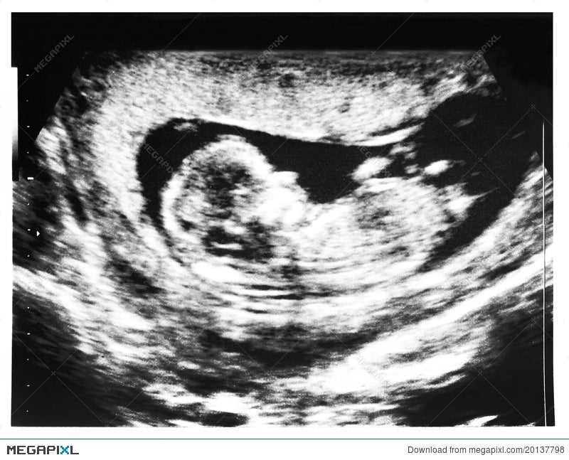 Baby Ultrasound 2d Echo Stock Photo Megapixl