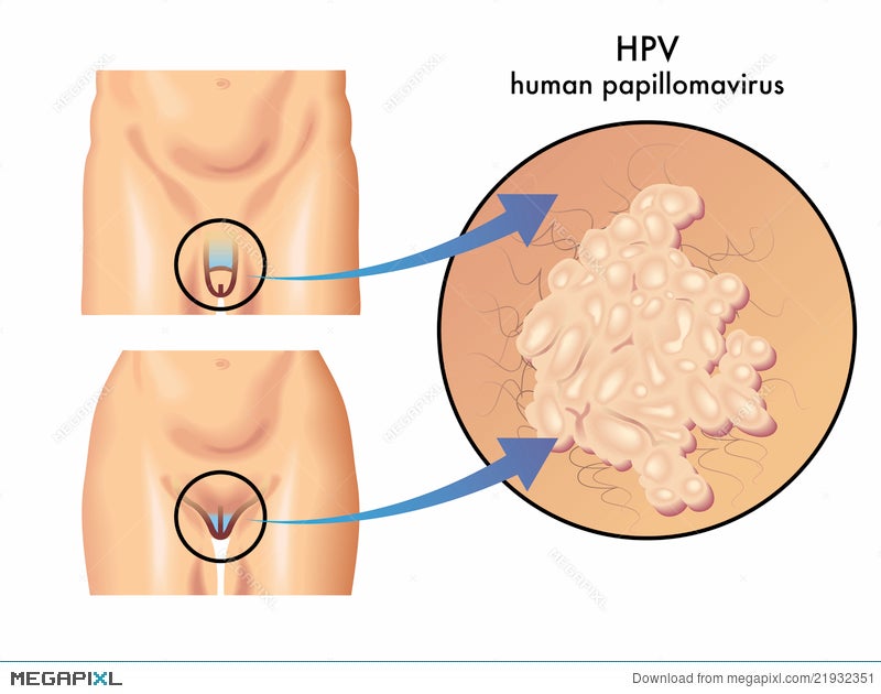 recenzii de papilomavirus uman