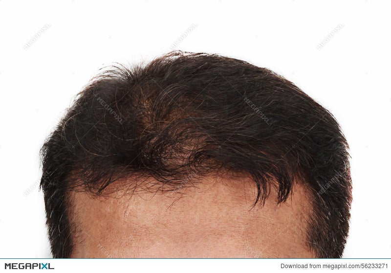 Hair Loss Male Head With Hair Loss Symptoms Front Side Stock