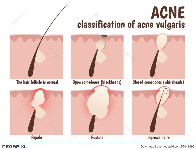 Structure Of The Hair Follicle Illustration 57441999 Megapixl