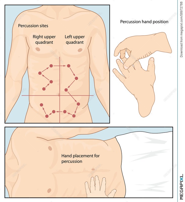 Abdominal Percussion Technique Illustration 58972788 Megapixl