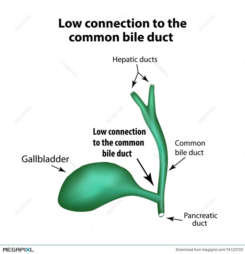 Low Connection To The Common Bile Duct. Pathology Of The Gallbladder
