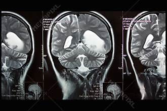 MRI of brain, left hemisphere tumor, coronal plane