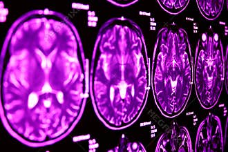 Magnetic Resonance of Brain, blue MR