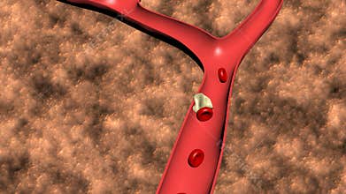 Animation of the formation of thrombosis