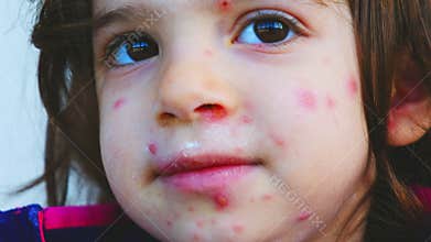 Chickenpox rash close up red dots skin condition on children face details pus