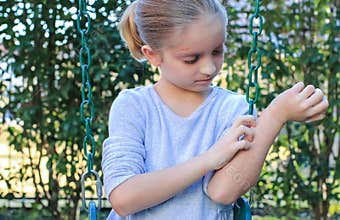 Girl with Eczema on Arms and Face