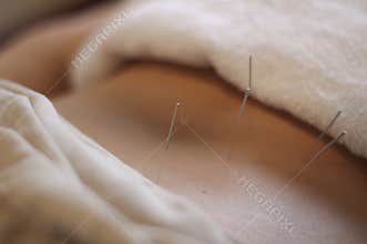 Acupuncture Needle