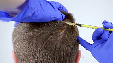 Hair mesotherapy or hair transplant: a beautician doctor makes injections in the man’s head for hair growth or to prevent