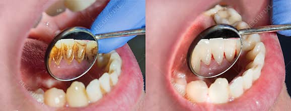 Plaque of the patient, stone. Dentistry treatment of dental plaque, professional oral hygiene. The concept of harm to smoking and