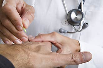 Acupuncture