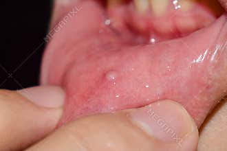Small vesicle lesion at lower lip
