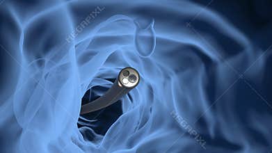 Endoscope with colonic polyp