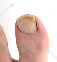 Onychomycosis on the first toe.