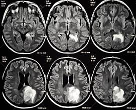 Brain tumor