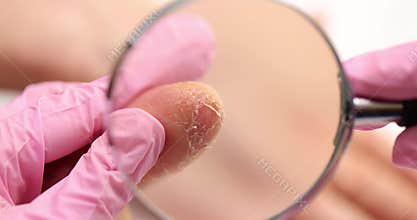 Doctor examines peeling eczema skin on patient finger through magnifying glass.
