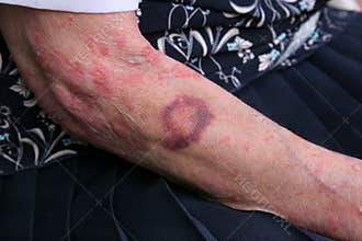 Bruising and Sceriosis