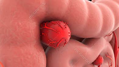 Intestinal Colon Polyp Growth Animation on Pink Intestine Anatomy with Red Blood Vessels for Medical Visualization of