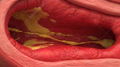 Detailed View of Atherosclerosis in Red Blood Vessel Showing Yellow Plaque Formation for Medical Educational Purposes