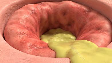 Close Up Animated Colonoscopy Visualization of Human Colon with Polyp Growth for Medical Education and Pharmaceutical