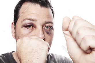 Black eye injury boxer violence isolated