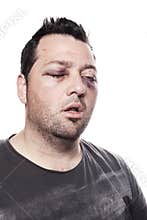 Black eye injury accident violence isolated