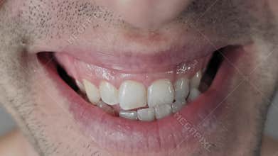 Woman's Mouth with Acne Smiling Widely