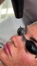 Young woman getting carbon laser facial at beauty clinic. Professional skincare