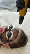 Young woman getting carbon laser facial at beauty clinic. Professional skincare