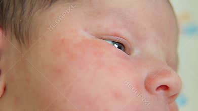 Close-up of a newborn baby with skin Allergy lying on the bed in the hospital.