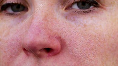 Couperose on the nose of a young attractive girl. Capillary mesh treatment concept. Acne on the face. Examination by a doctor