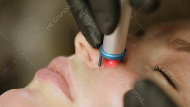 Close-up removal of blood vessels on the face of a diode laser in a spa salon.