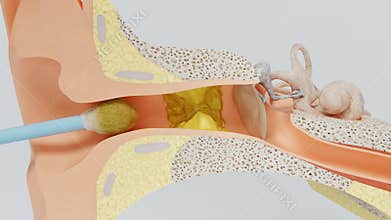 Wrong way of ear cleaning