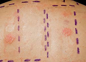 Skin Allergy Test