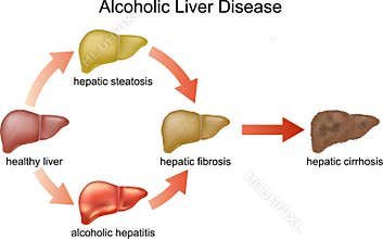 Alcoholic Liver Disease