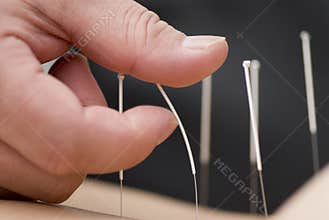 Treatment by acupuncture