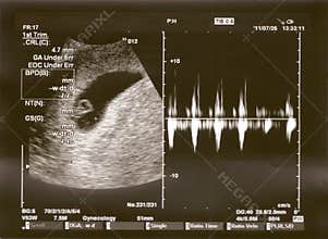 Ultrasound baby