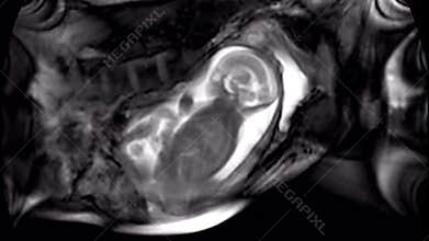 Ultrasonography of pregnant woman.  MRI of baby