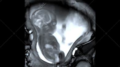 Ultrasonography of pregnant woman.  MRI of baby