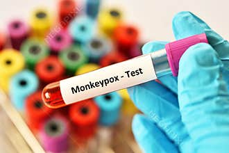 Blood sample for Monkeypox test