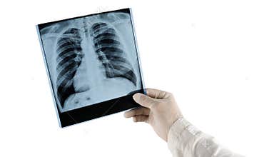 X-ray of a human lung is isolated on a white background  the doctor analyzes the X-ray of the lungs