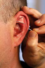Acupuncture In Ear