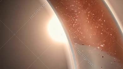 Observing cholesterol accumulation within an artery and its health implications