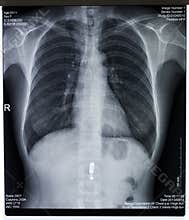 X-ray image of chest