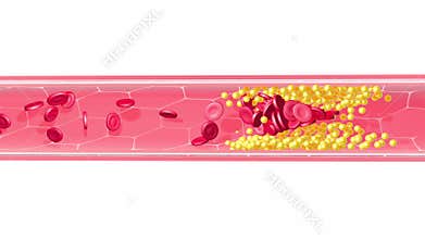 Anatomical 3D animation of the interior of an artery clogged by fat accumulation.