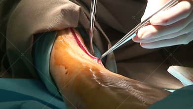 Surgery of leg