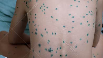 Chickenpox on child's back