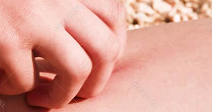 scratching an insect bite on reddened skin on the beach.