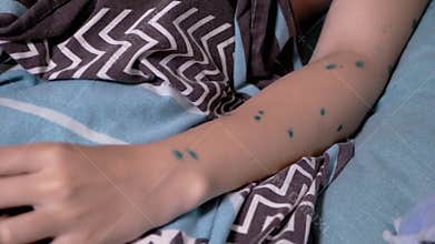 Chickenpox on Teen's Arm, Close Up